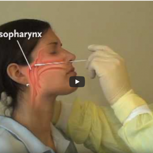 Einen Naso- bzw. Oropharynx Abstrich richtig machen